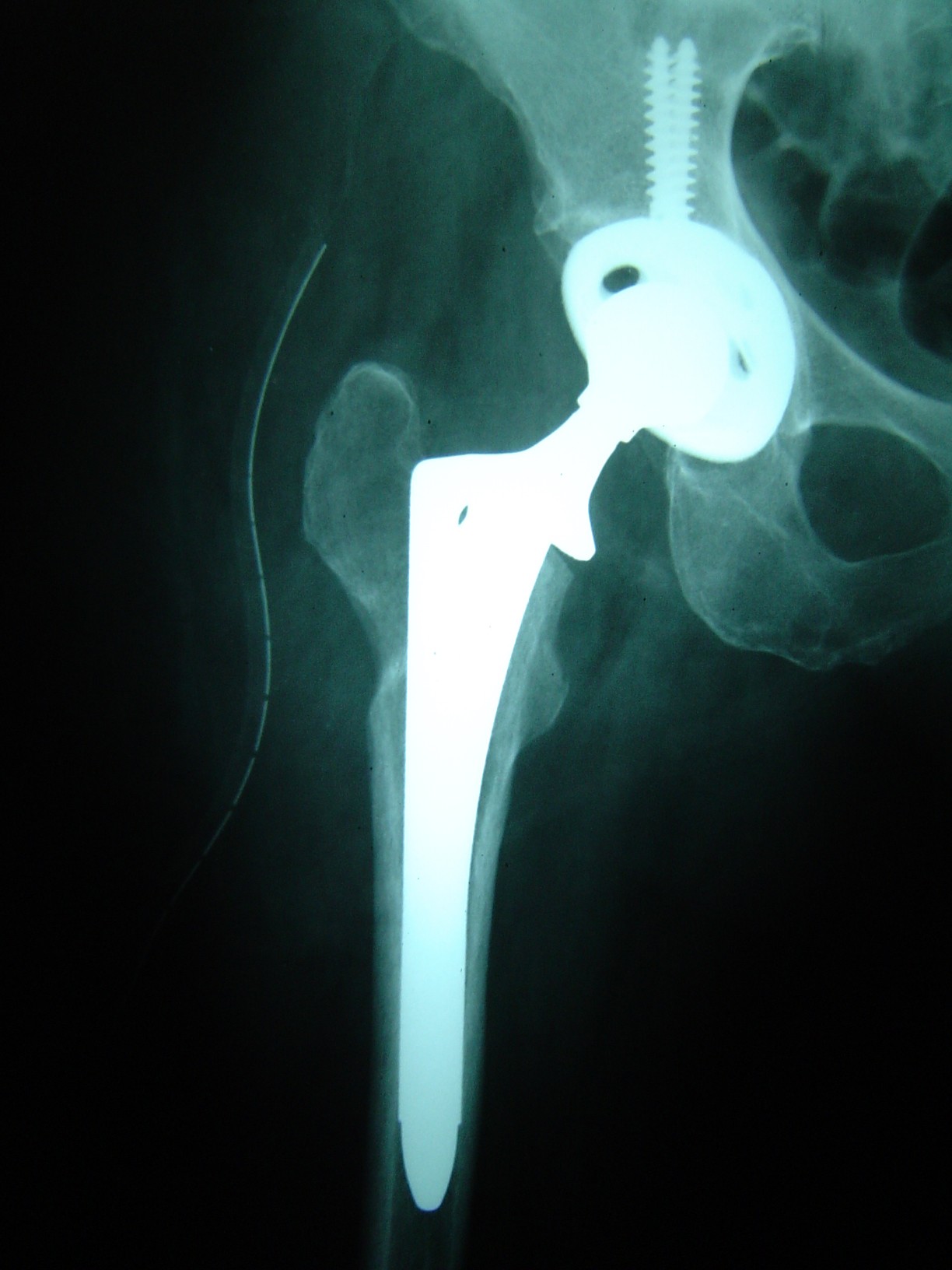 Post Operative X-Ray Non Cemented Hip Replacement